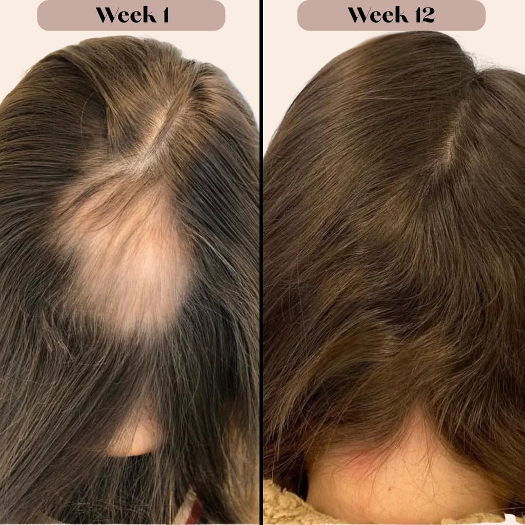 MicroInfusion Hair Regrowth System